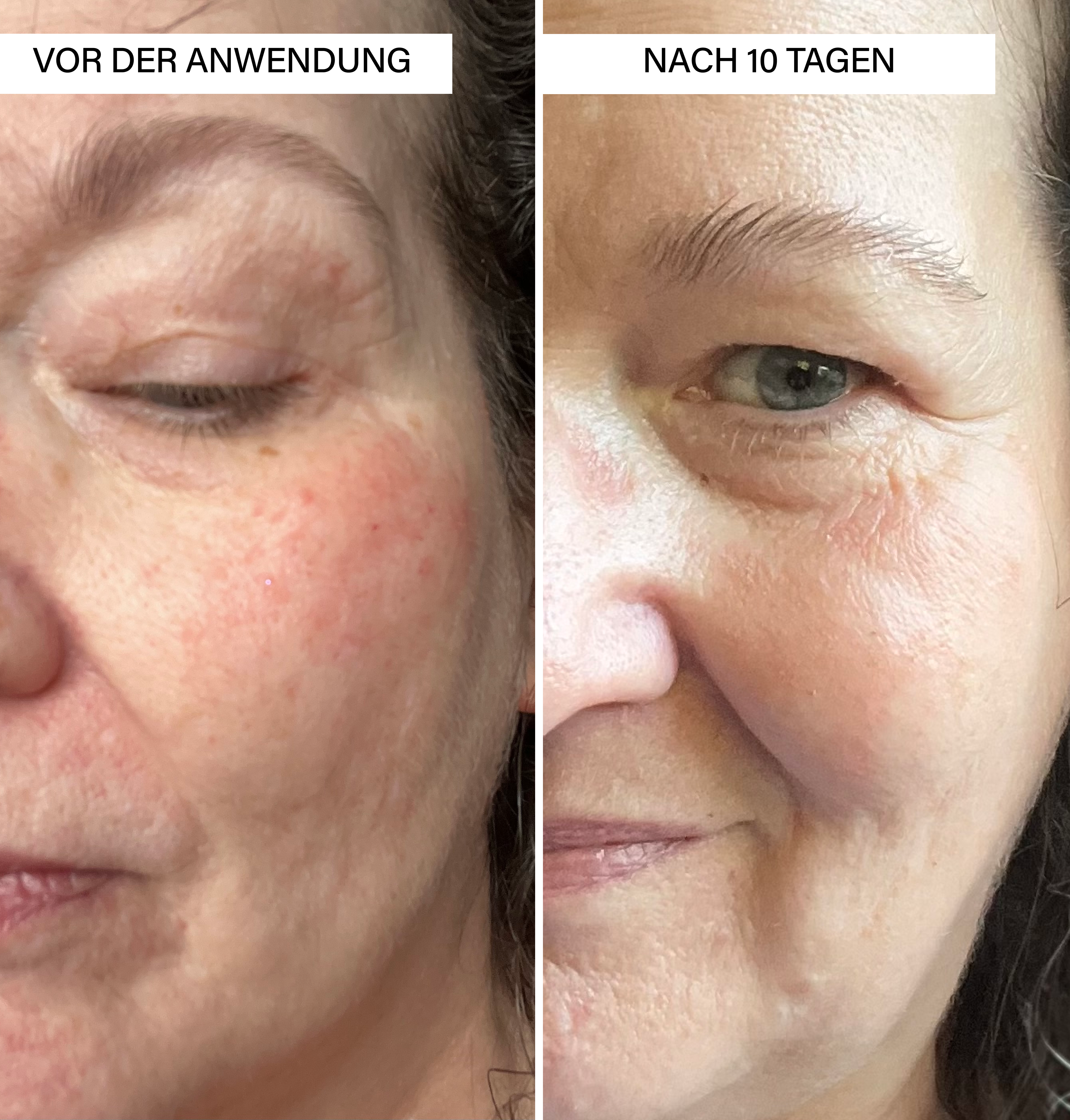 Anti-Hyperpigmentation Set