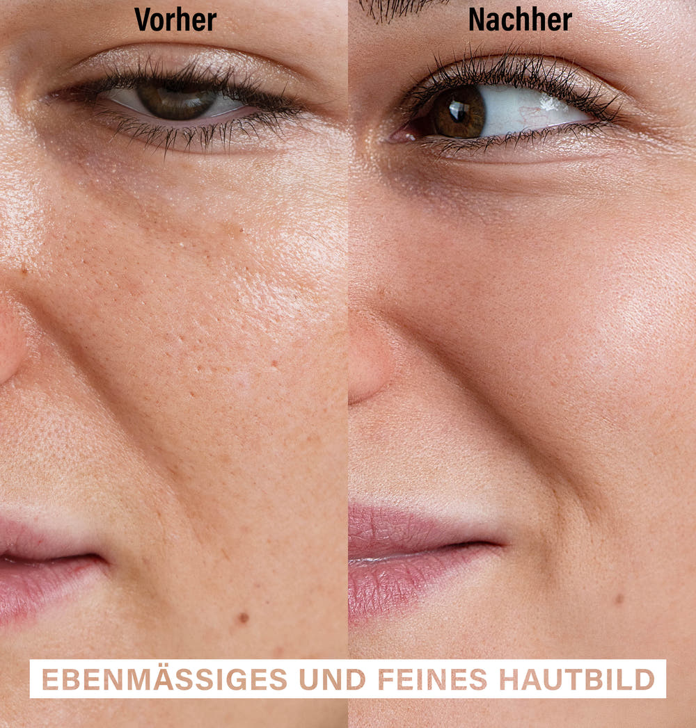 Skin Exfoliating Peeling | Pore-Refining Treatment